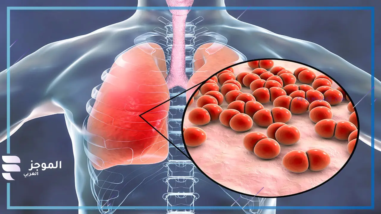 أسباب الإصابة بفيروس الالتهاب الرئوي