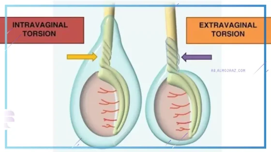 أعراض التواء الخصية للرضيع ... طريقة التشخيص والعلاج