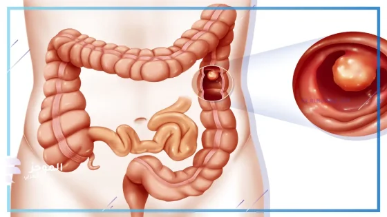 الحالات الخطرة لزوائد القولون: أعراض ظهور الزوائد في القولون وأسباب تشكلها 