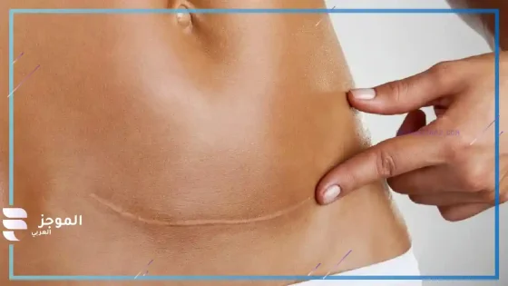 تفسير حلم شق البطن في المنام وإجراء عملية شق بطن